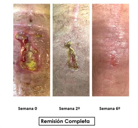 pre-post-tratamiento_curacion