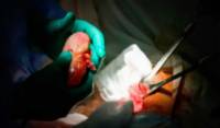 Trasplante_renal_1_x2