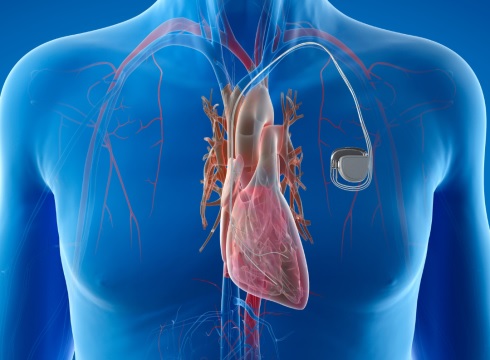 Noticia Banner Marcapasos